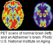 Fluorescent Scans May Have Potential to Track Alzheimer's Progression
