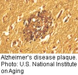 Research Hints at How Alzheimer's Affects the Brain