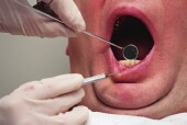 Tooth Cavities Linked to Lower Risk of Head, Neck Cancer in Study