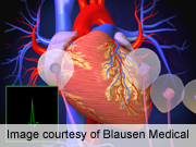 Hospitalization Rates Soar for Irregular Heartbeat, Study Finds
