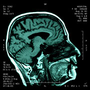 Concussion's Damage to Brain Lingers After Symptoms Fade: Study