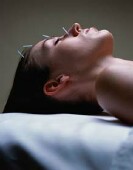 Acupuncture No Better Than 'Sham' Version in Breast-Cancer Drug Study