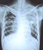 Could Stem Cells Cure Drug-Resistant Tuberculosis?