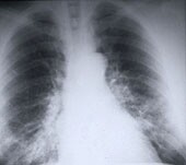 U.S. Lung Cancer Rates Continue to Drop: CDC