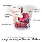 'Gastric Banding' Patients Often Have Dietary Issues, Study Finds