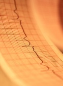 Implanted Monitor May Help Spot Dangerous Heart Rhythm After Stroke