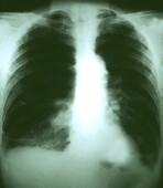 Tuberculosis in U.S. Hits Record Low: CDC