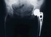 Hip Replacement Safe for Patients in Their 90s, Study Finds