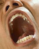 Complication Rate After Adult Tonsillectomy Higher Than Thought