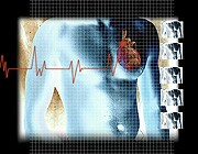 Heart Failure Drug Might Help Reduce Hospitalizations