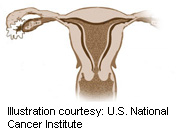 FDA Warns Against Procedure for Uterine Fibroids