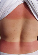 5 or More Bad Sunburns While Young Tied to Higher Melanoma Risk