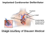 Implanted Defibrillators May Help Patients With Moderate Heart Failure