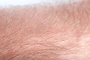 Hairless Man Now Hairy, Thanks to Arthritis Drug