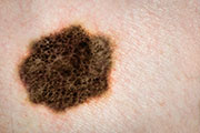 Use Your 'ABCDE' to Spot Deadly Skin Cancer