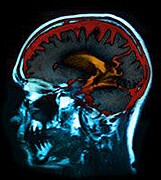 Antipsychotics Linked to Lower Brain Volume in Schizophrenia Patients