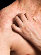 New Eczema Drug Shows Promise in Early Trials