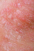 New Psoriasis Drug Shows Promise in Trials