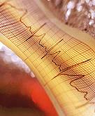 Common Irregular Heartbeat May Pose Risks for Surgery Patients