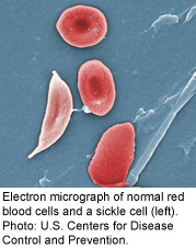 Blood Transfusions May Cut Risk of 'Silent' Stroke in Kids With Sickle Cell