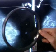 2 Genetic Variants for Breast Cancer Identified