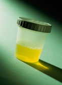 Urine Test Shows Promise for Early Diagnosis of Kidney Cancer