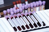 Americans' Blood Triglyceride Levels Dropping: CDC