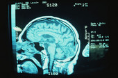 White Matter Damage in Brain May Help Spot Early Alzheimer's