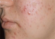 Could a Vitamin Play a Role in Acne Outbreaks?