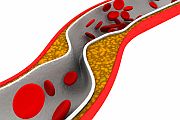 Seeing Their Clogged Arteries Can Spur Healthy Changes in Patients