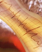 Too Few Older Heart Attack Patients Get Implanted Defibrillators, Study Finds