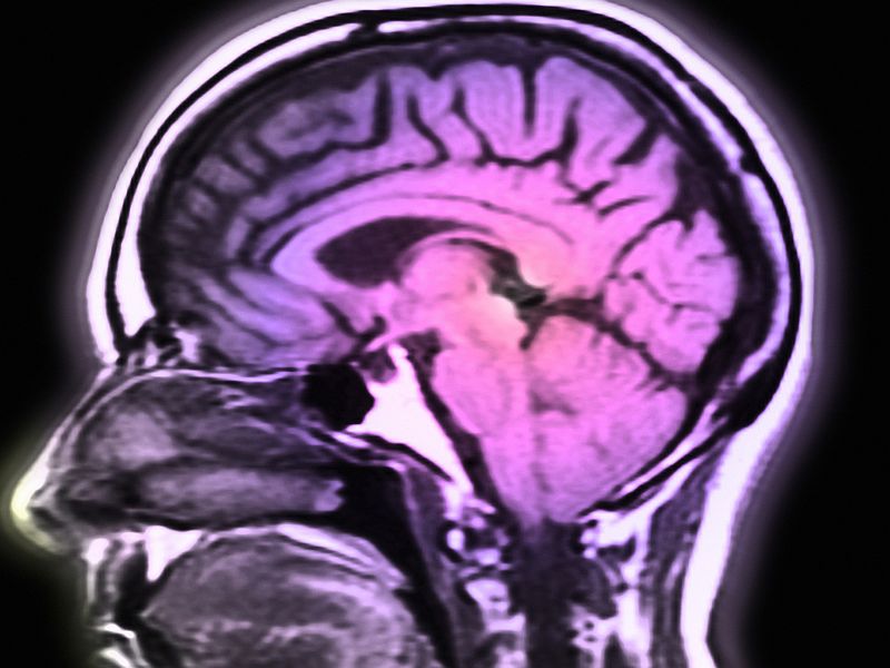 Brain Scans May Reveal Which Coma Patients Will Recover